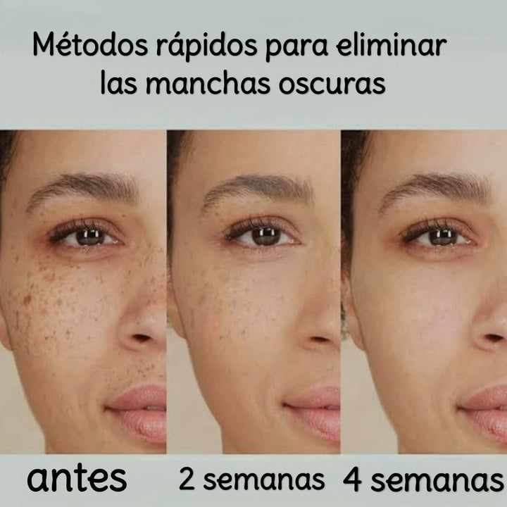 Dark spot crema aclaradora