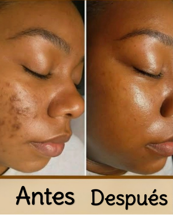 Dark spot crema aclaradora