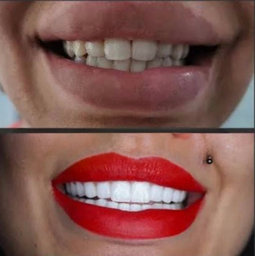 Tira Blanqueadora Dental x 7 Pares x2