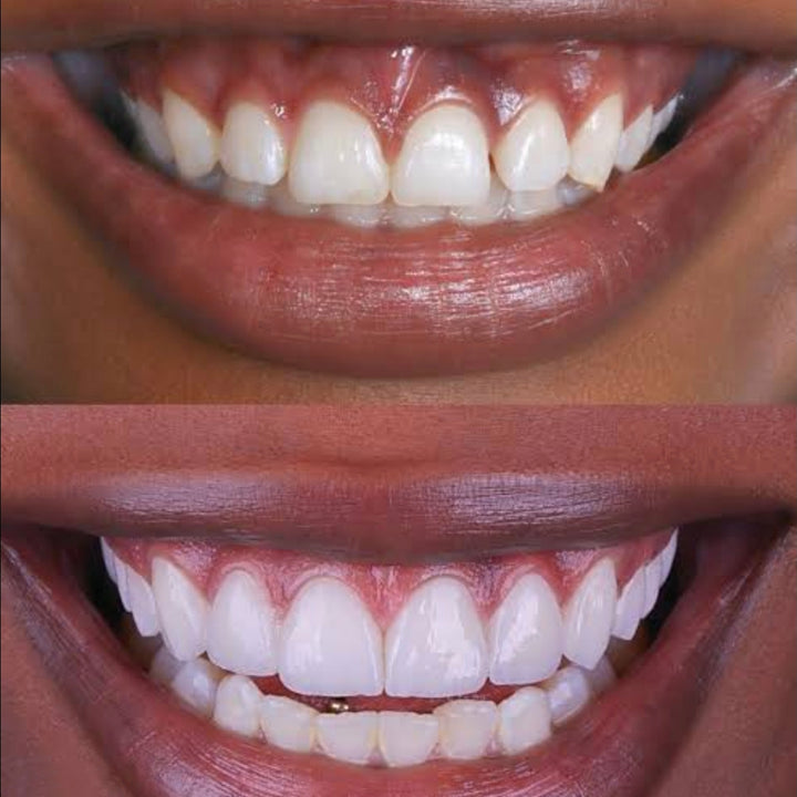 Tira Blanqueadora Dental x 7 Pares x2