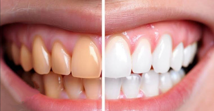 Tira Blanqueadora Dental x 7 Pares x2